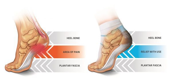 What is Plantar Fasciopathy What is Plantar Fasciopathy