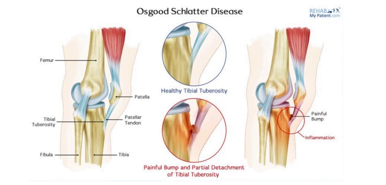 Tibial Tuberosity Bump Treatment Tibial Tuberosity Bump Treatment